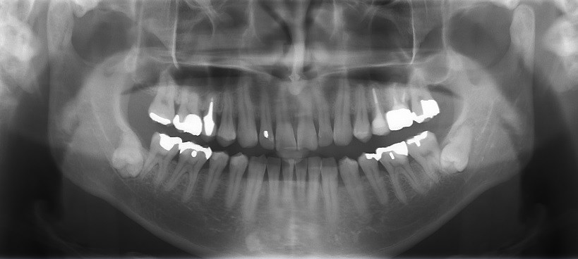 親知らずのレントゲン写真｜やましろ歯科口腔外科